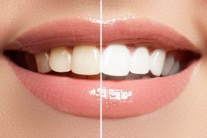 Dra. Vanessa Bocanegra 3 blanqueamiento dental dentista CD