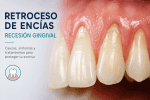 Retroceso de Encías (Recesión Gingival): Causas, Grados y Cómo Frenarlo 3 Retroceso de Encías