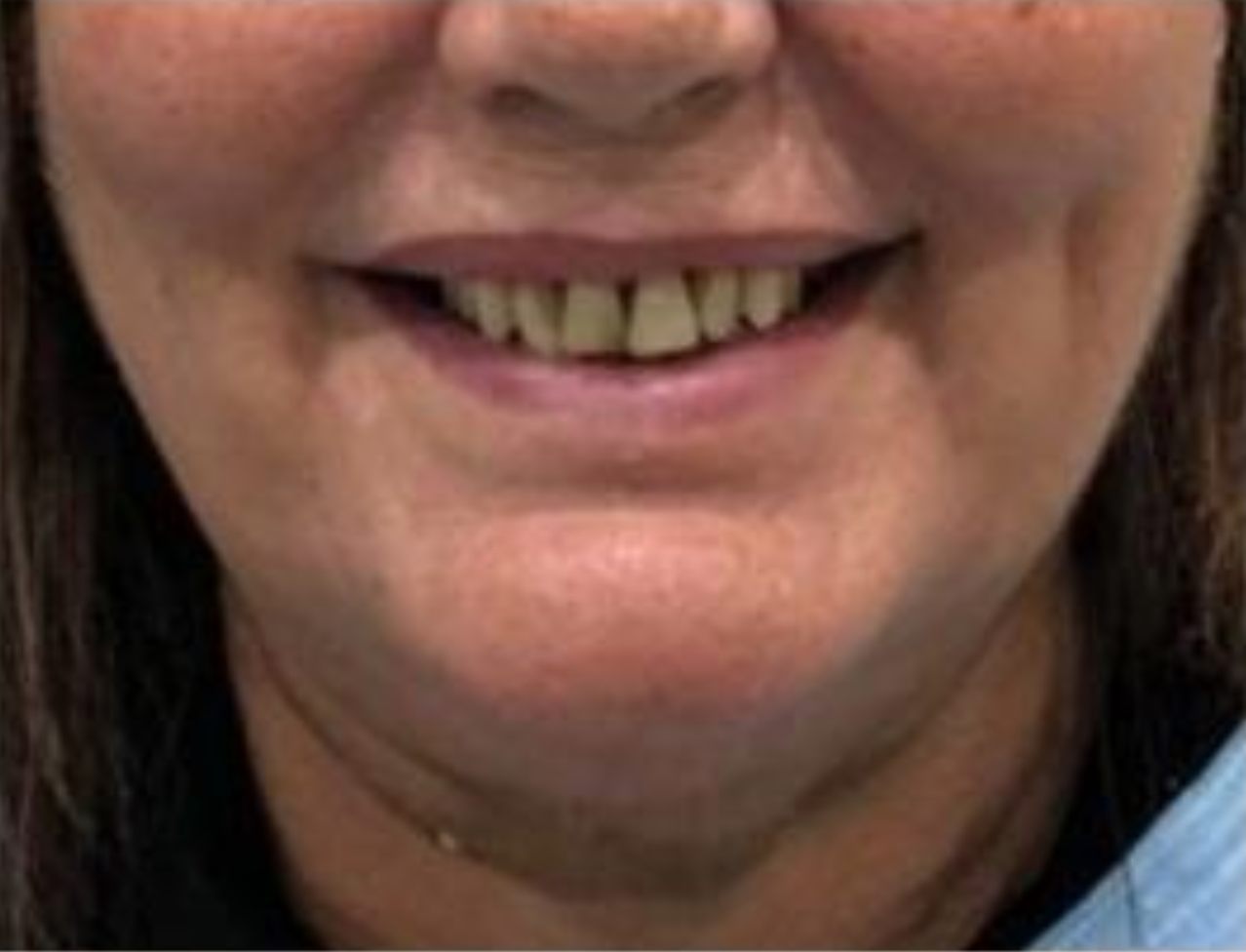 recuperar masticacion y estetica dental antes