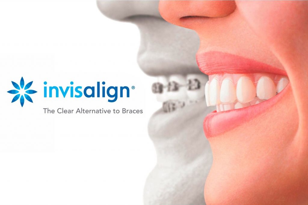 Invisalign: la ortodoncia invisible de la que todos hablan
