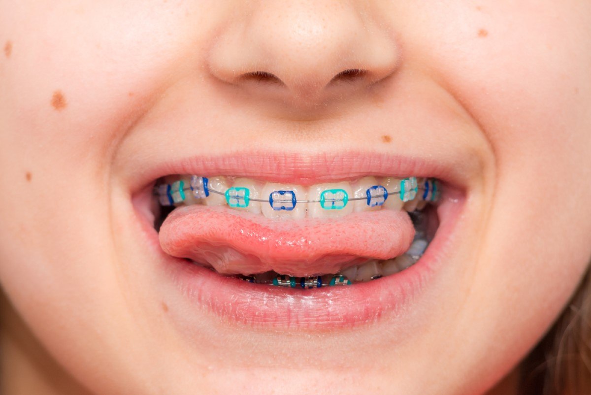 ¿Por qué llevar a los niños al ortodoncista?