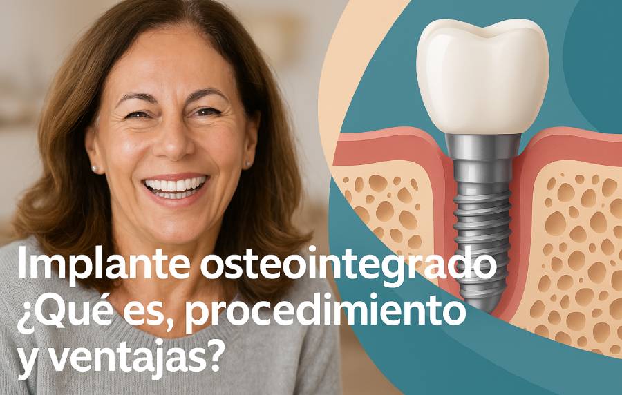 Blog 1 que es un implante osteointegrado
